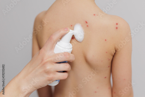 Fotografie Child skin infected with chickenpox is having treatment using antiseptic foam