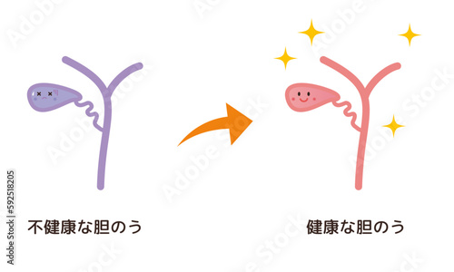 不健康な胆のう→健康な胆のうのイメージ