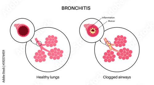 Bronchitis lung disease