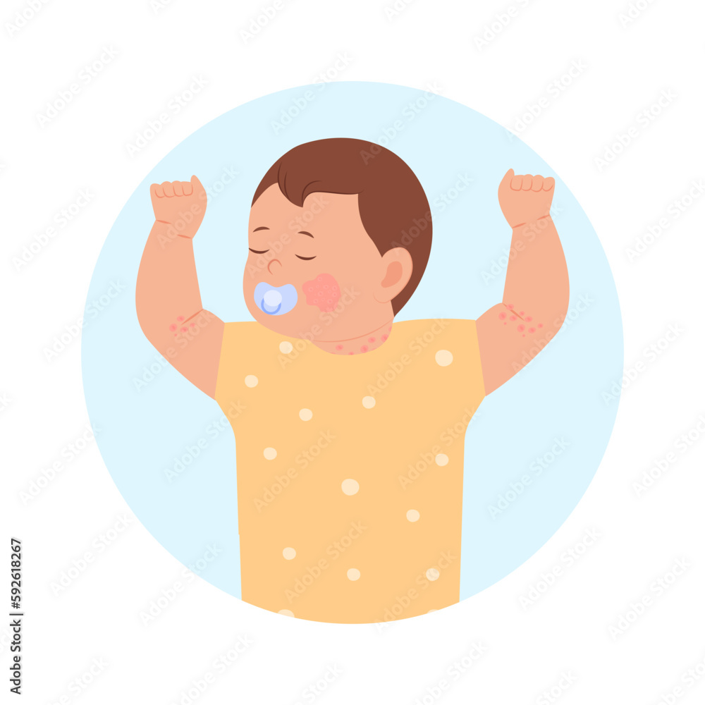 Pediatric Eczema or Atopic Dermatitis in infants and children. Baby with diaper rash, skin rash, allergy. Redness of skin in children.Dermatological problems. Vector illustration Pediatric Eczema or Atopic Dermatitis in infants and children. Baby with diaper rash, skin rash, allergy. Redness of skin in children.Dermatological problems. Vector illustration