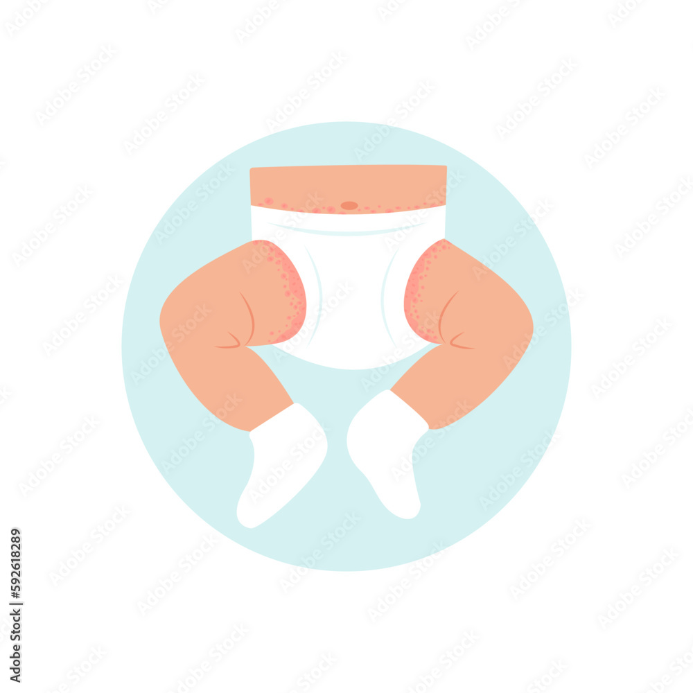 Infant with diaper rash. Redness of the skin in the groin and abdomen