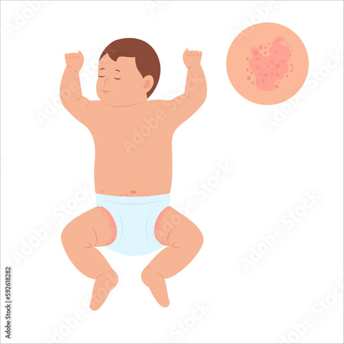 Baby with diaper rash, skin rash, allergy. Redness of skin in children.Dermatological problems. Vector illustration