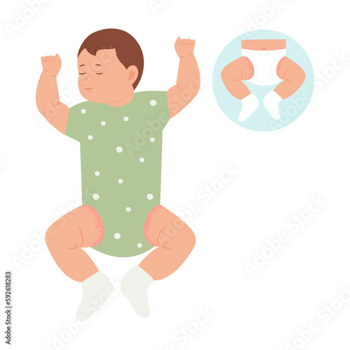 Baby with diaper rash, skin rash, allergy. Redness of skin in children.Dermatological problems. Vector illustration