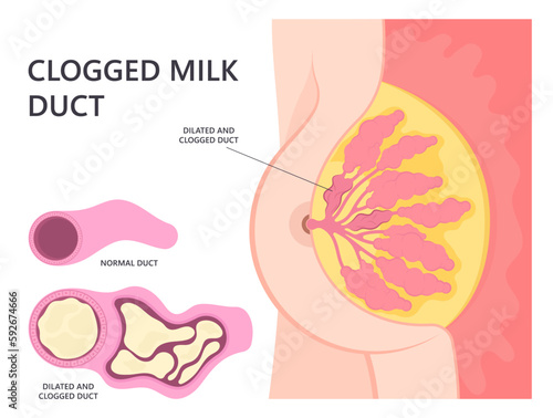 Skin lymph nodes pus abscess mastitis swelling breast gland engorgement cyst cancer Pregnancy lump baby newborn pump care sore tumor lactational pain