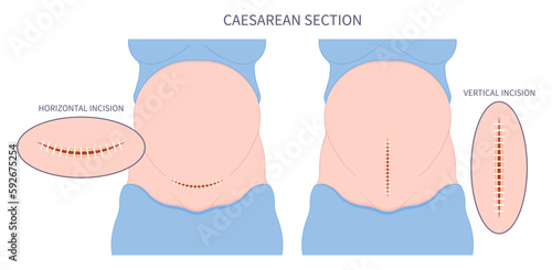 Tummy Scar Childbirth Delivery Caesarean C section newborn Baby birth prolapse umbilical cord twins womb women infant Fetal fetus mother belly Labour feet pain born medical photo