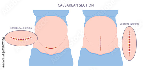 Tummy Scar Childbirth Delivery Caesarean C section newborn Baby birth prolapse umbilical cord twins womb women infant Fetal fetus mother belly Labour feet pain born medical