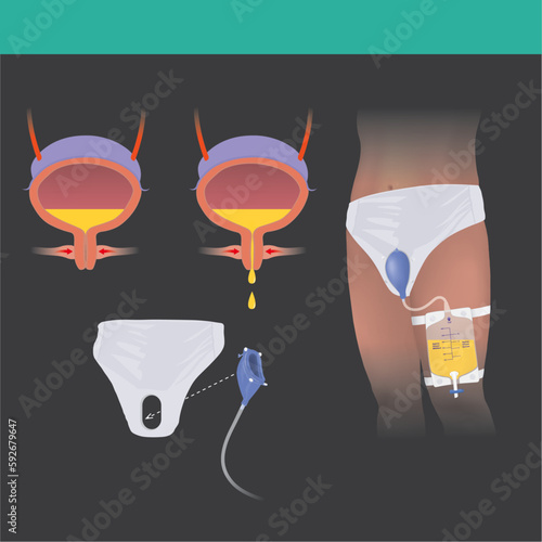Urinary Incontinence. Urine filling cone device for bedridden patient or has Urinary Incontinence problems..