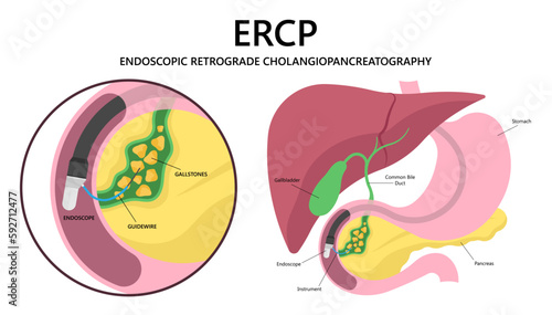 cholecystitis tract infection surgery gallbladder Gallstones choledocholithiasis Endoscopic Retrograde Cholangiopancreatography or ERCP Common cancer pancreatitis cholangitis stone bile duct removal  photo