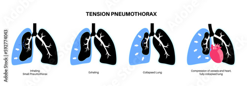 Tension pneumothorax poster