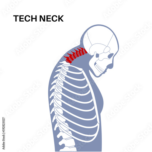 Neck vertebrae deformity