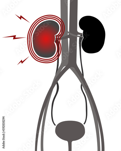 Urinary system. Kidneys bladder ureters. Inflammation of the kidney. 