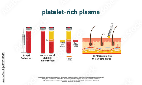 Platelet-Rich plasma procedure stages / prp / Centrifuge vector