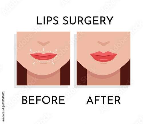 Lips Surgery correction Vector illustration. Plastic and aesthetic surgery concept. Beauty Procedure  on woman Face with dotted lines on lips and anatomical zones Up and Down flat design cartoon style