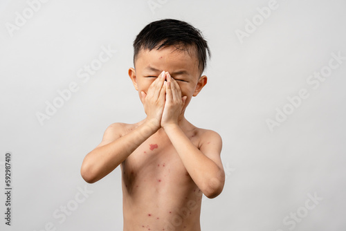 Εκτύπωση καμβά A 7 year old Asian boy has chickenpox