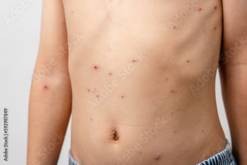 A 7 year old Asian boy has chickenpox. pimples on the body of child with chickenpox