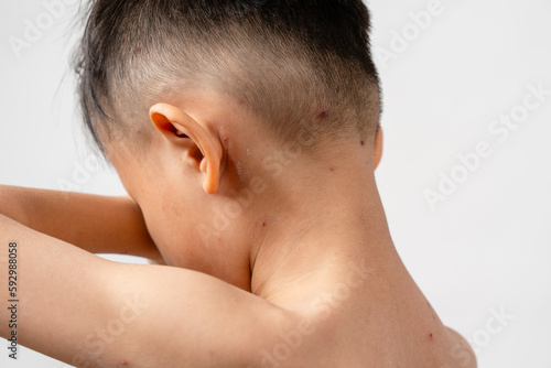 Φωτογραφία A 7 year old Asian boy has chickenpox