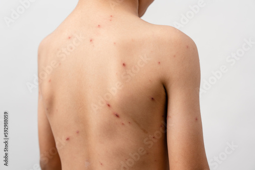Εκτύπωση καμβά A 7 year old Asian boy has chickenpox
