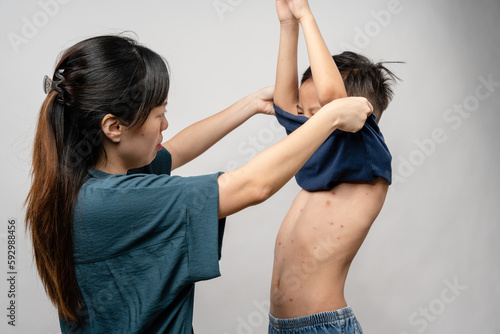 Φωτογραφία A mother is applying itching ointment to him 7 year old Asian boy suffering from chickenpox