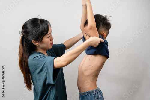 Φωτογραφία A mother is applying itching ointment to him 7 year old Asian boy suffering from chickenpox