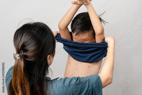 Εκτύπωση καμβά A mother is applying itching ointment to him 7 year old Asian boy suffering from chickenpox