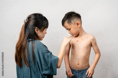 Obraz na plátně A mother is applying itching ointment to him 7 year old Asian boy suffering from chickenpox