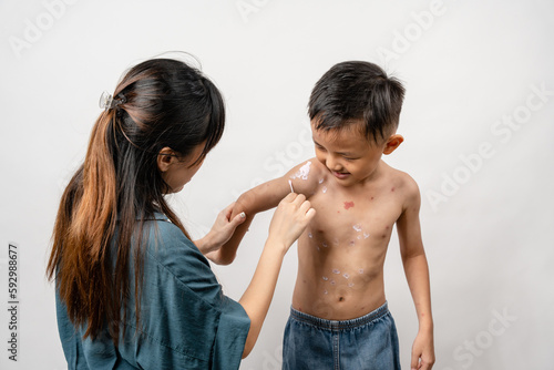 Φωτογραφία A mother is applying itching ointment to him 7 year old Asian boy suffering from chickenpox