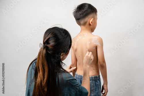 Φωτογραφία A mother is applying itching ointment to him 7 year old Asian boy suffering from chickenpox