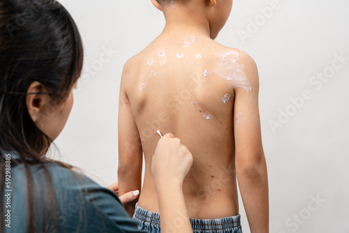 Εκτύπωση καμβά A mother is applying itching ointment to him 7 year old Asian boy suffering from chickenpox