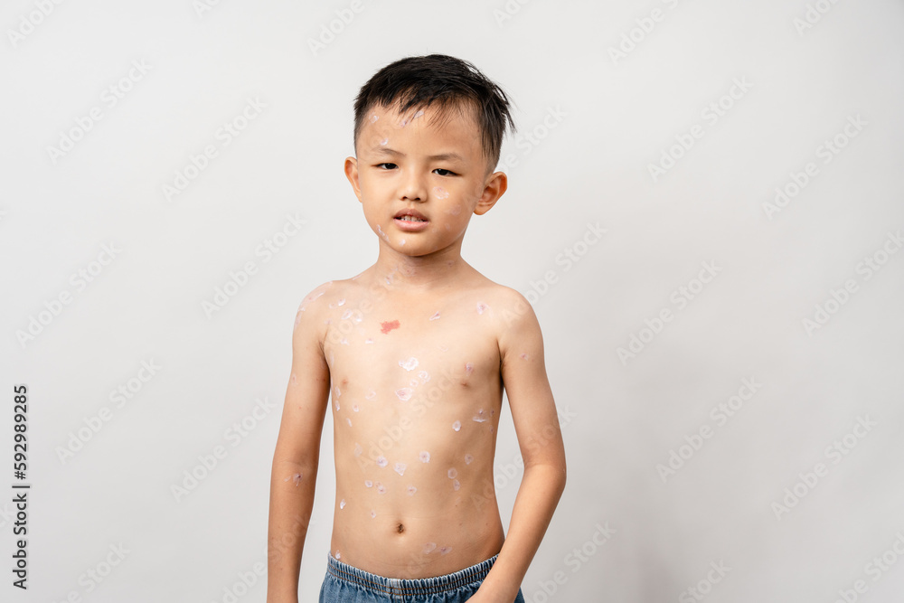 Fotografie A 7 year old Asian boy has chickenpox