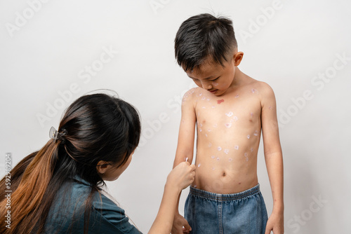 Εκτύπωση καμβά A mother is applying itching ointment to him 7 year old Asian boy suffering from chickenpox