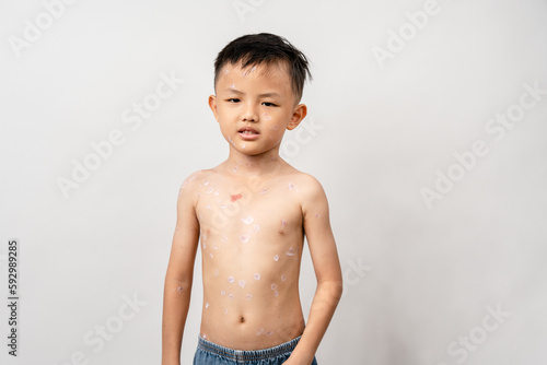 Foto A 7 year old Asian boy has chickenpox
