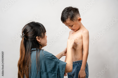 Obraz na plátne A mother is applying itching ointment to him 7 year old Asian boy suffering from chickenpox