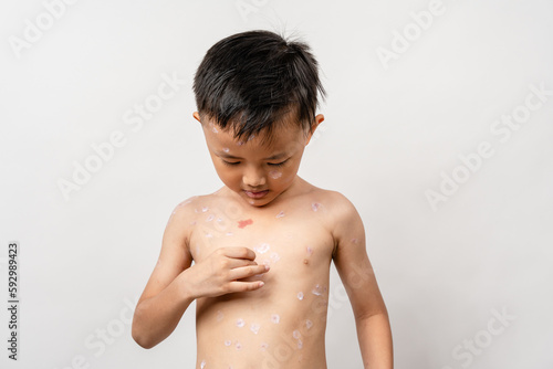 Fotografie A 7 year old Asian boy has chickenpox