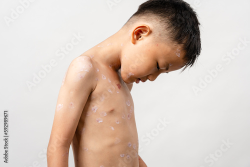 Φωτογραφία A 7 year old Asian boy has chickenpox