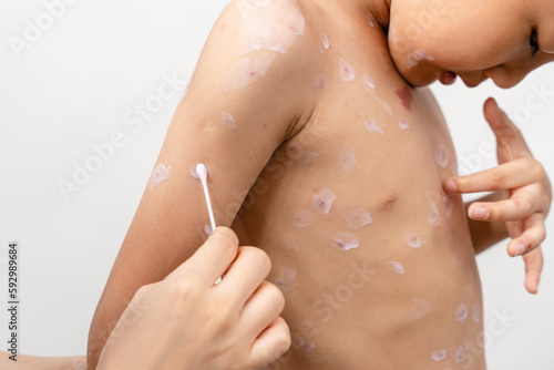 Φωτογραφία A 7 year old Asian boy has chickenpox