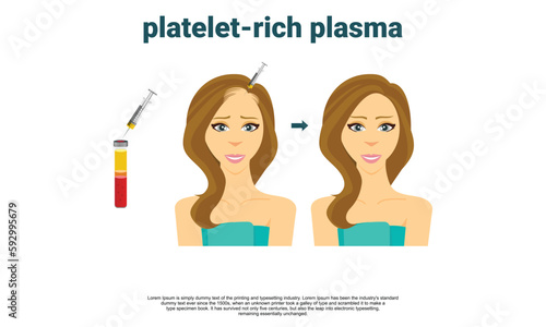 Platelet rich plasma injection procedure. PRP therapy process.  hair loss treatment infographics. Meso therapy. Hair growth stimulation. Vector illustration