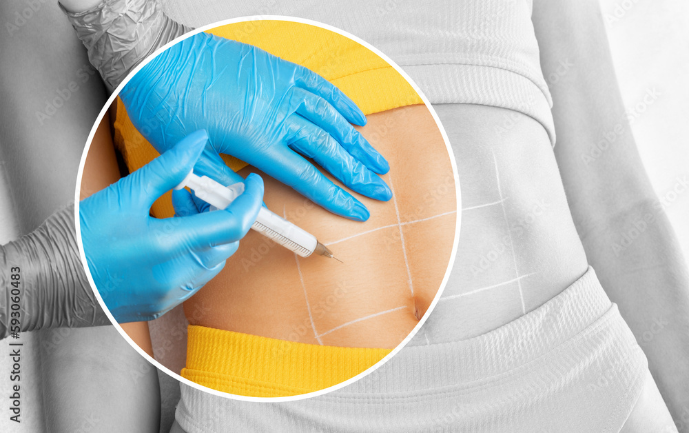 cosmetologist makes lipolytic injections to burn fat on the stomach and ...