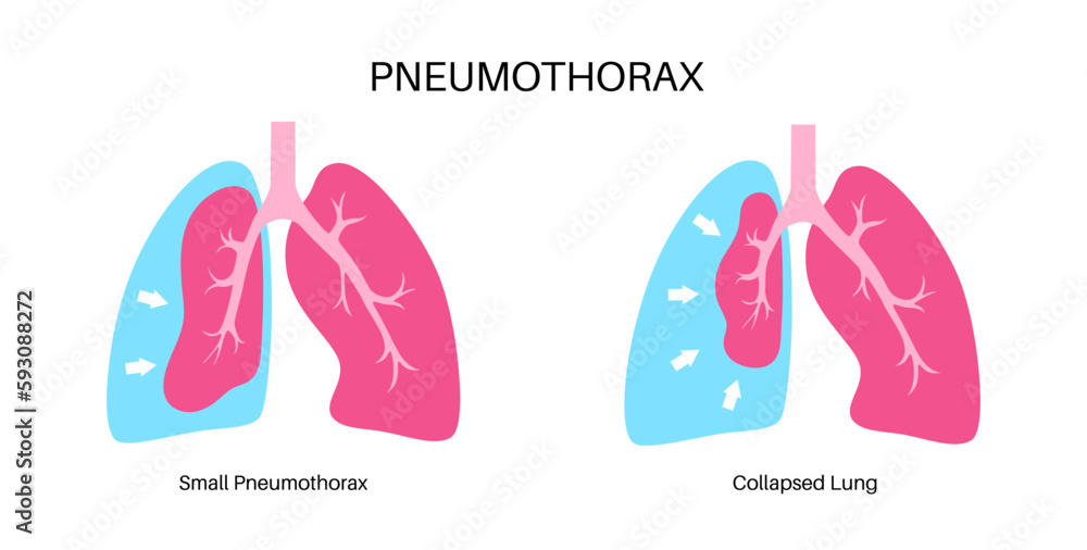 Pneumothorax anatomical poster