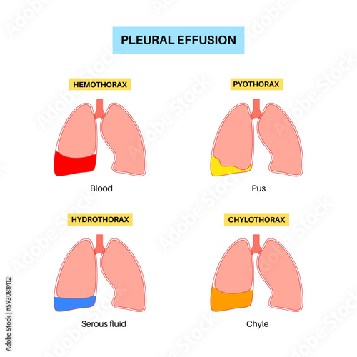 Pleural effusion poster