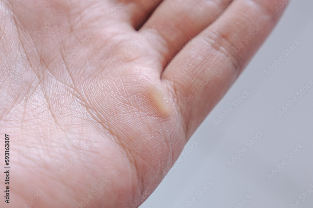 Selective focus of man hand with callus on palm Selective focus of man hand with callus on palm
