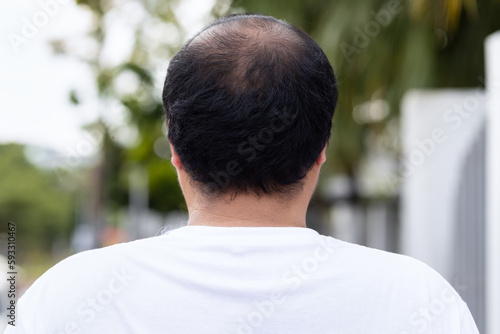 Middle aged asian man with early stage baldness and hair loss problem