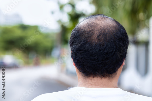 Middle aged asian man with early stage baldness and hair loss problem
