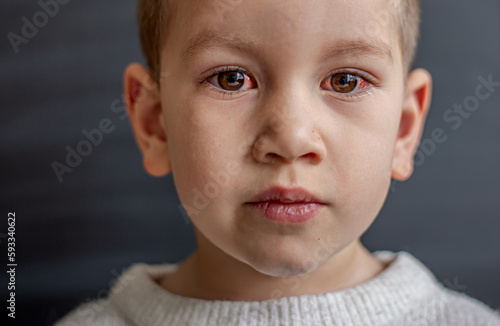 Wallpaper Mural A young child with spoiled eyes suffers from conjunctivitis.Close up of a severe bloodshot eye. Torontodigital.ca