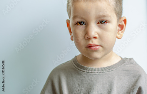 Wallpaper Mural A young child with spoiled eyes suffers from conjunctivitis.Close up of a severe bloodshot eye. Torontodigital.ca