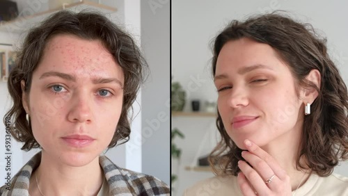 Two close up faces of young caucasian woman show real result before and after acne treatment. Split screen. Home background. Concept  of acne therapy, scars, inflammation on face and problem skin photo