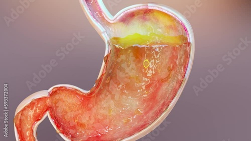 human stomach with gases. Bloating and flatulence, flatulence and gastrointestinal tract, Bloating digestion system, stomach ache or cramps, gastritis, stomachache, indigestion, vomiting, 3d render photo