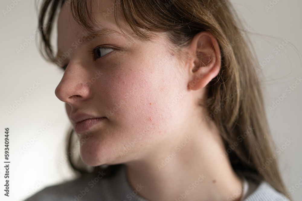 Problem skin face. A teenage girl with a troubled face. Problematic teenage skin. Care for problem skin. Acne remedy. Acne. Problem skin face. A teenage girl with a troubled face. Problematic teenage skin. Care for problem skin. Acne remedy. Acne.