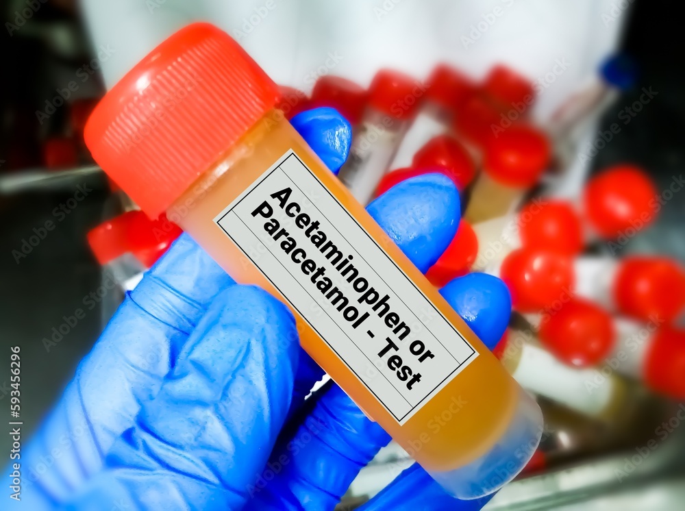 Urine sample for Acetaminophen and Paracetamol drug test, to diagnose