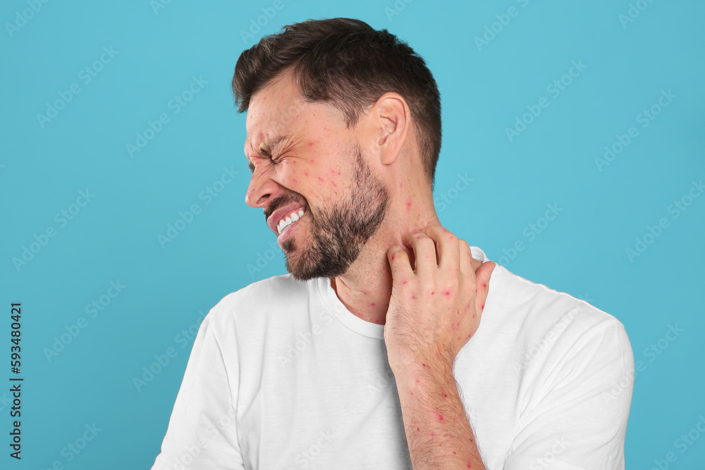 Man with rash suffering from monkeypox virus on light blue background Man with rash suffering from monkeypox virus on light blue background