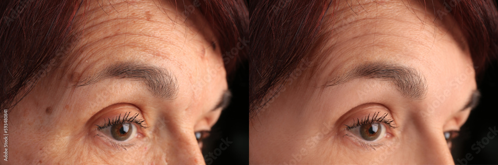 Fototapeta premium Woman looking better due to cosmetic procedures. Collage with photos before and after rejuvenation, closeup